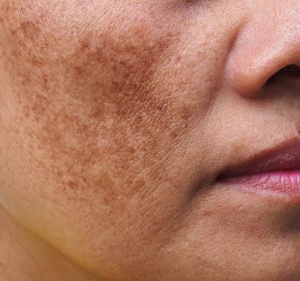 Hyperpigmentation treatment at Circle Care