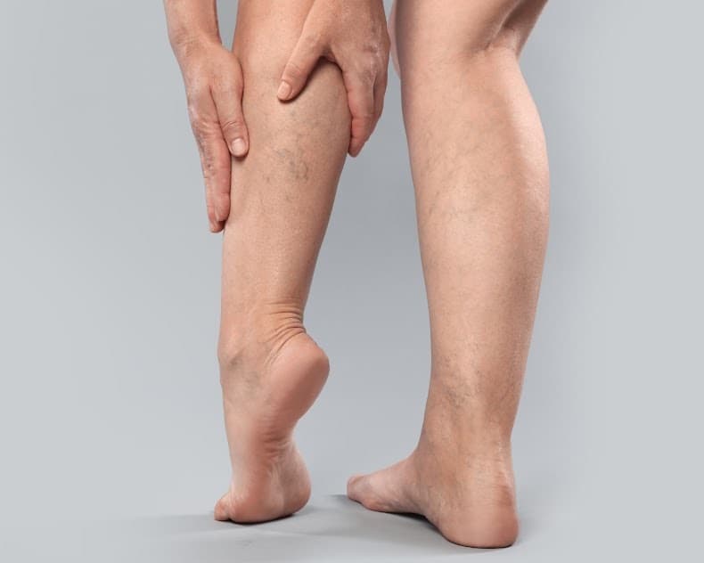 Legs showing varicose and spider veins