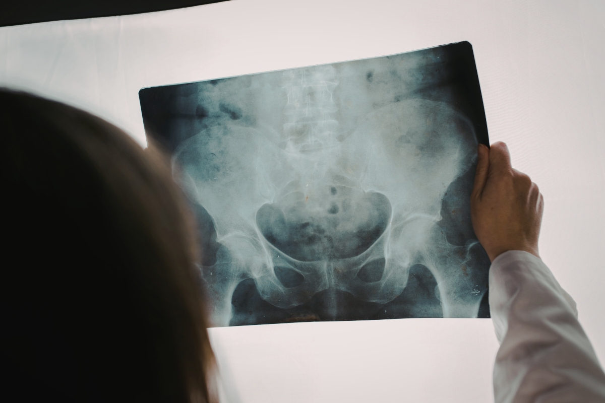 Pelvic Ray Image