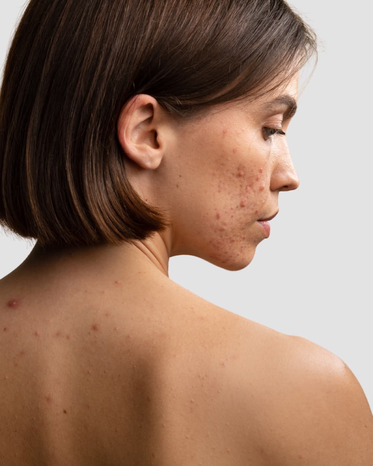 Acne treatment at Circle Care