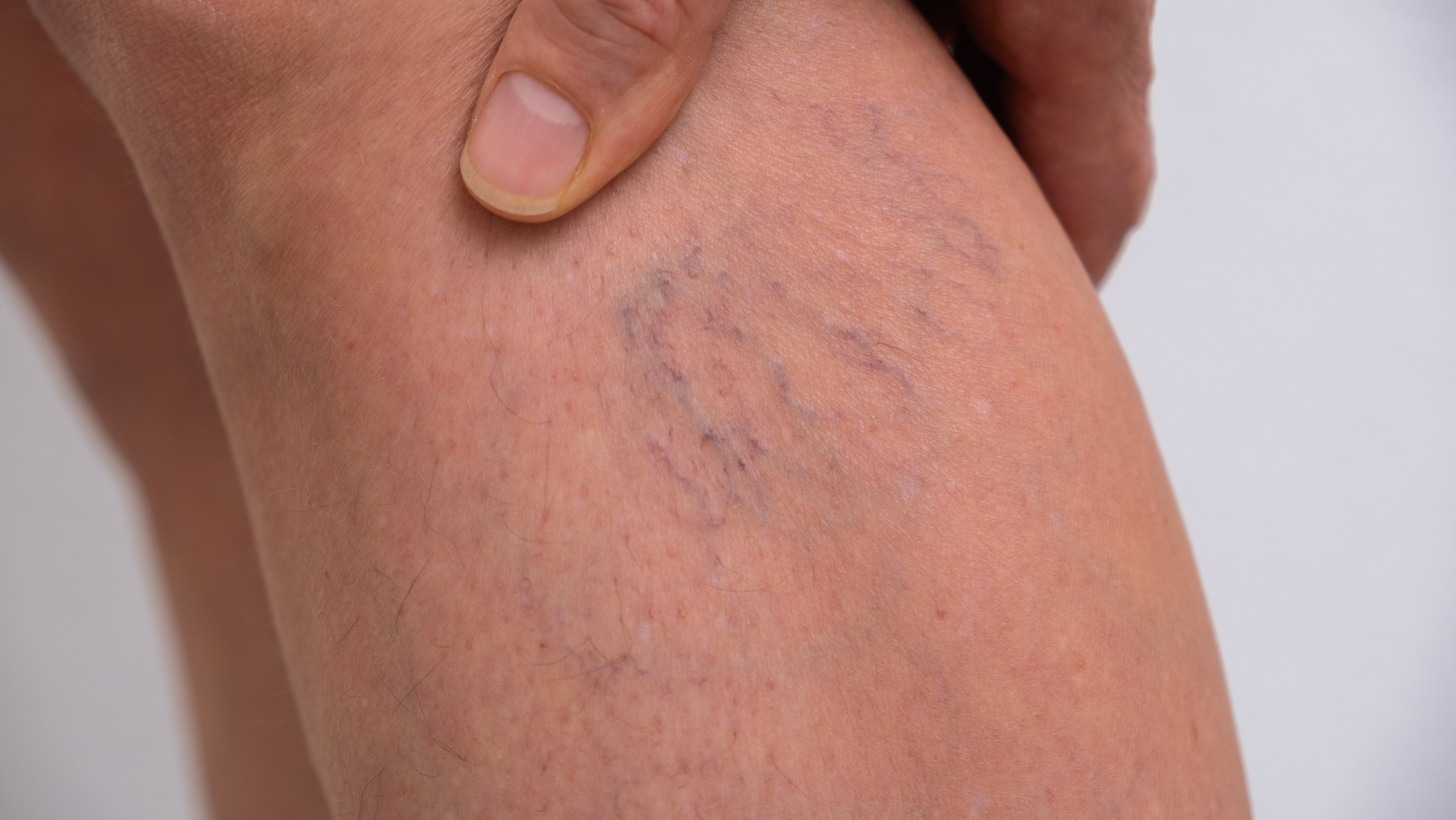 Close-up of spider veins on the leg