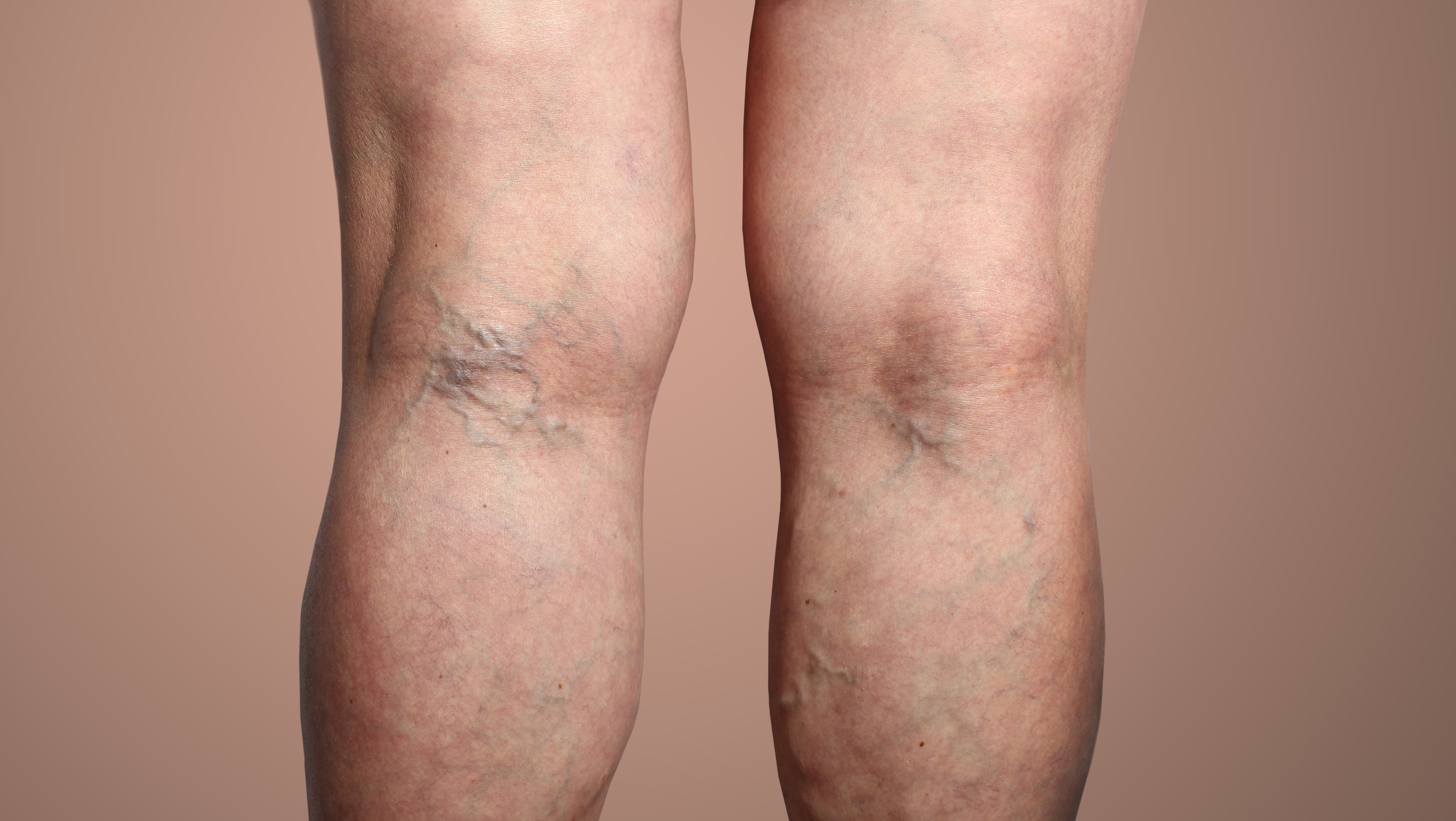 Visible varicose veins on the backs of the legs