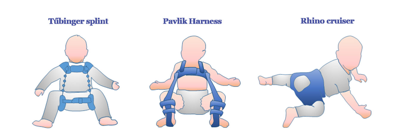 splints e1713898206725