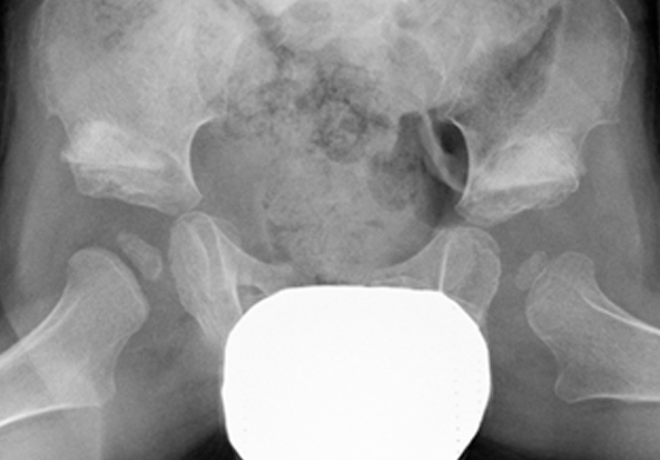 Hip Dysplasia - HIP Screen 12 b
