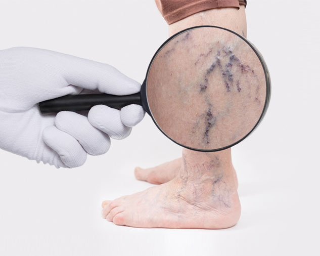 varicose-veins