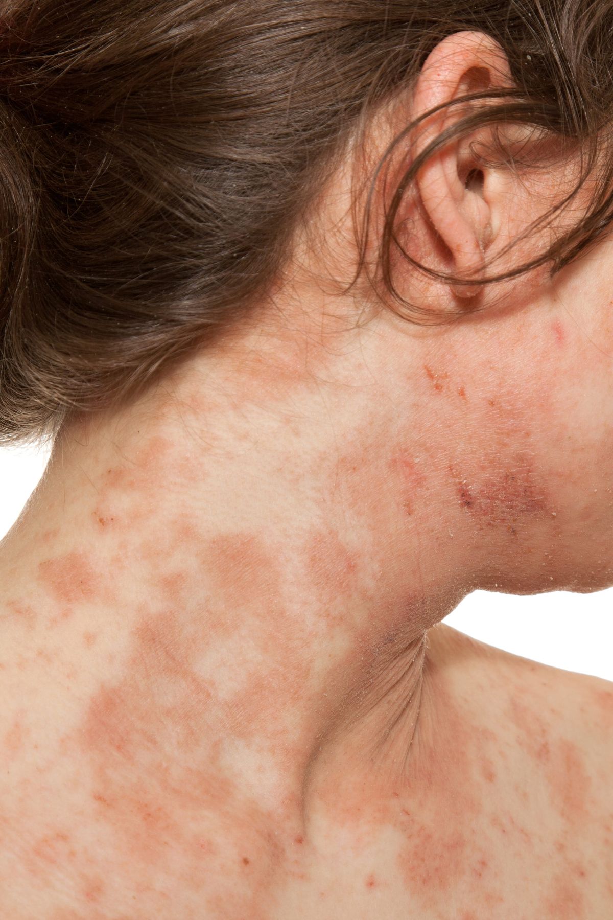 2 - Eczema