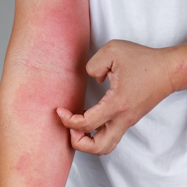 Eczema and Rashes