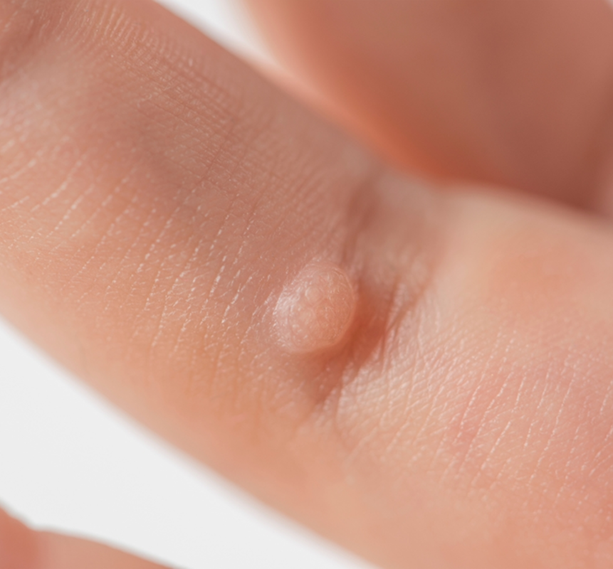 Warts